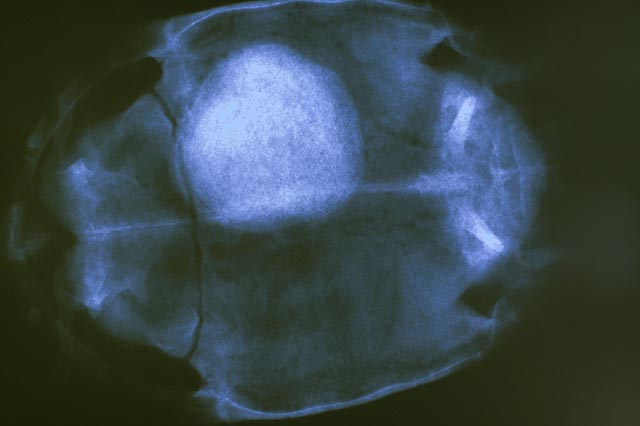 Large bladder stone